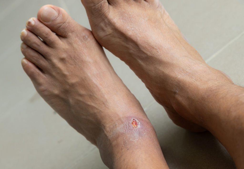 Leg or foot ulcers